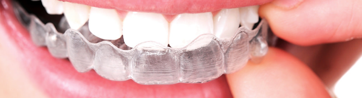 invisalign