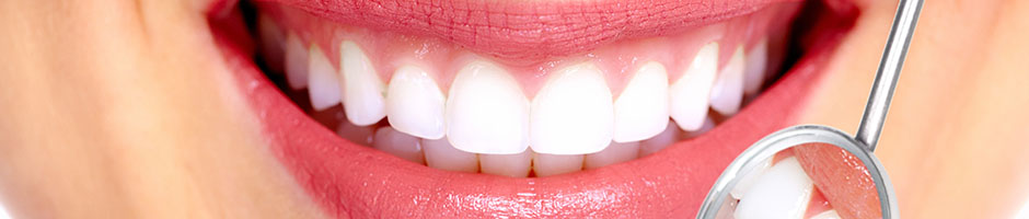 veneers