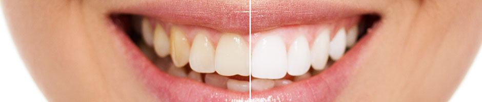 zoom-teeth-whitening